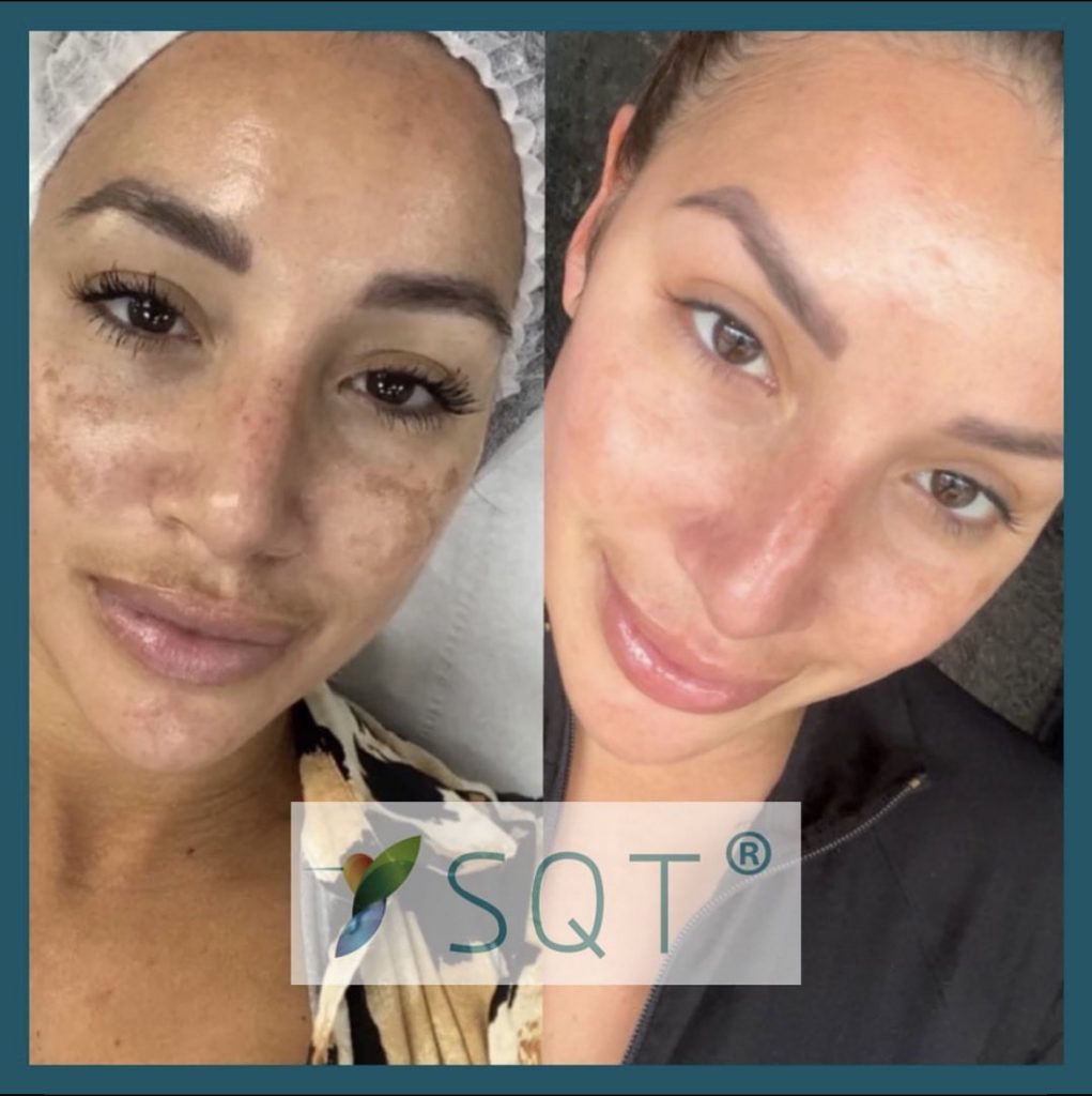 SQT bio-microneedling before and after